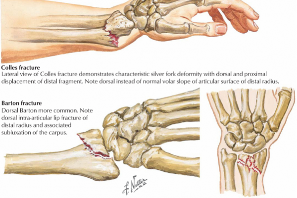 COLLES FRACTURE