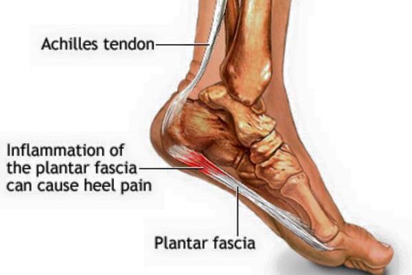 這幾種人容易發生足底筋膜炎（足跟痛）