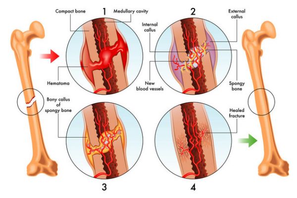 骨折的认识-骨折的痊愈-Bone Fracture Healing Process