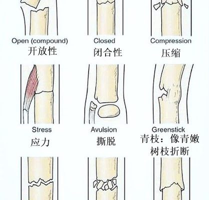 骨折的种类