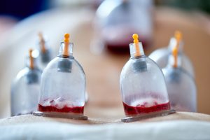 hijama